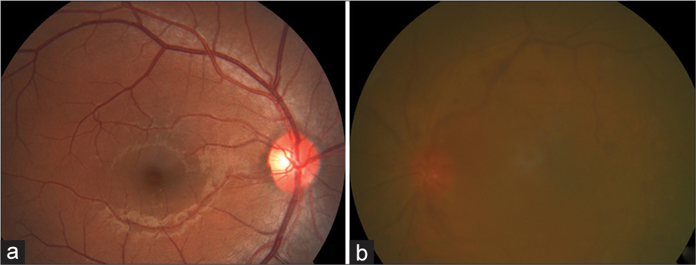 (a) Fundus image of a patient with early cataract and (b) fundus image of a patient with dense cataract.