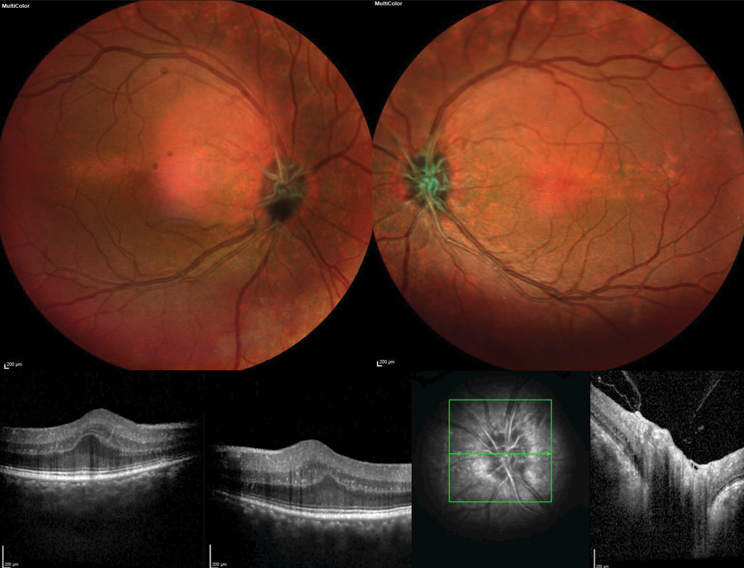 Secondary piggyback intraocular lens for posterior microphthalmos ...