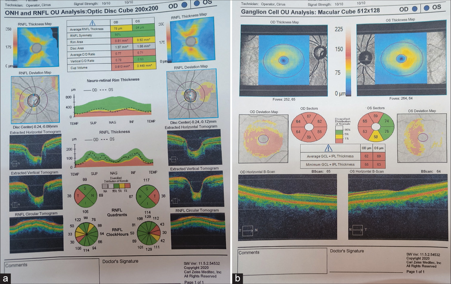 (a) Retinal nerve fibre layer (RNFL) optical coherence tomography showing temporal neuroretinal rim thinning and RNFL thinning in both eyes. (b) Ganglion cell map showing 360° thinning in the right eye and nasal thinning in the left eye.