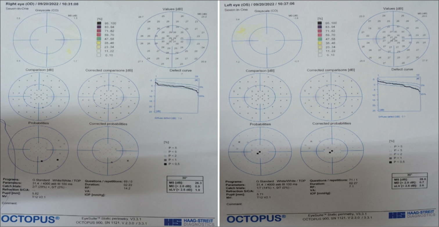 1st Perimetry report of this patient showing vertically aligned field defect in both eyes.