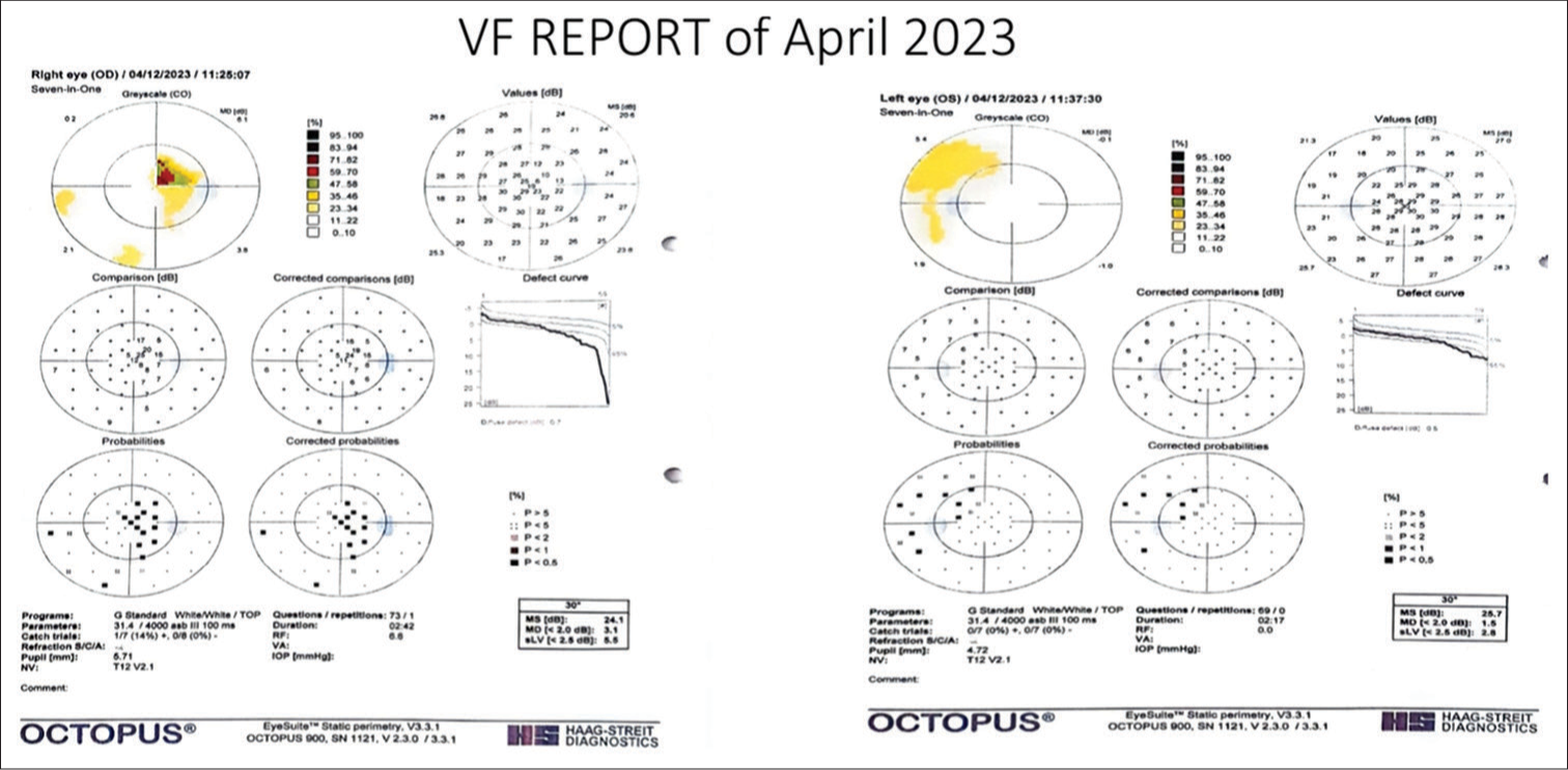 2nd Perimetry report of this patient was done after a 6-month interval of the 1st visual field report and before surgical intervention for ‘aneurysm’ at the junction of internal carotid artery and middle carotid artery, showing a vertically aligned field defect in both eyes.