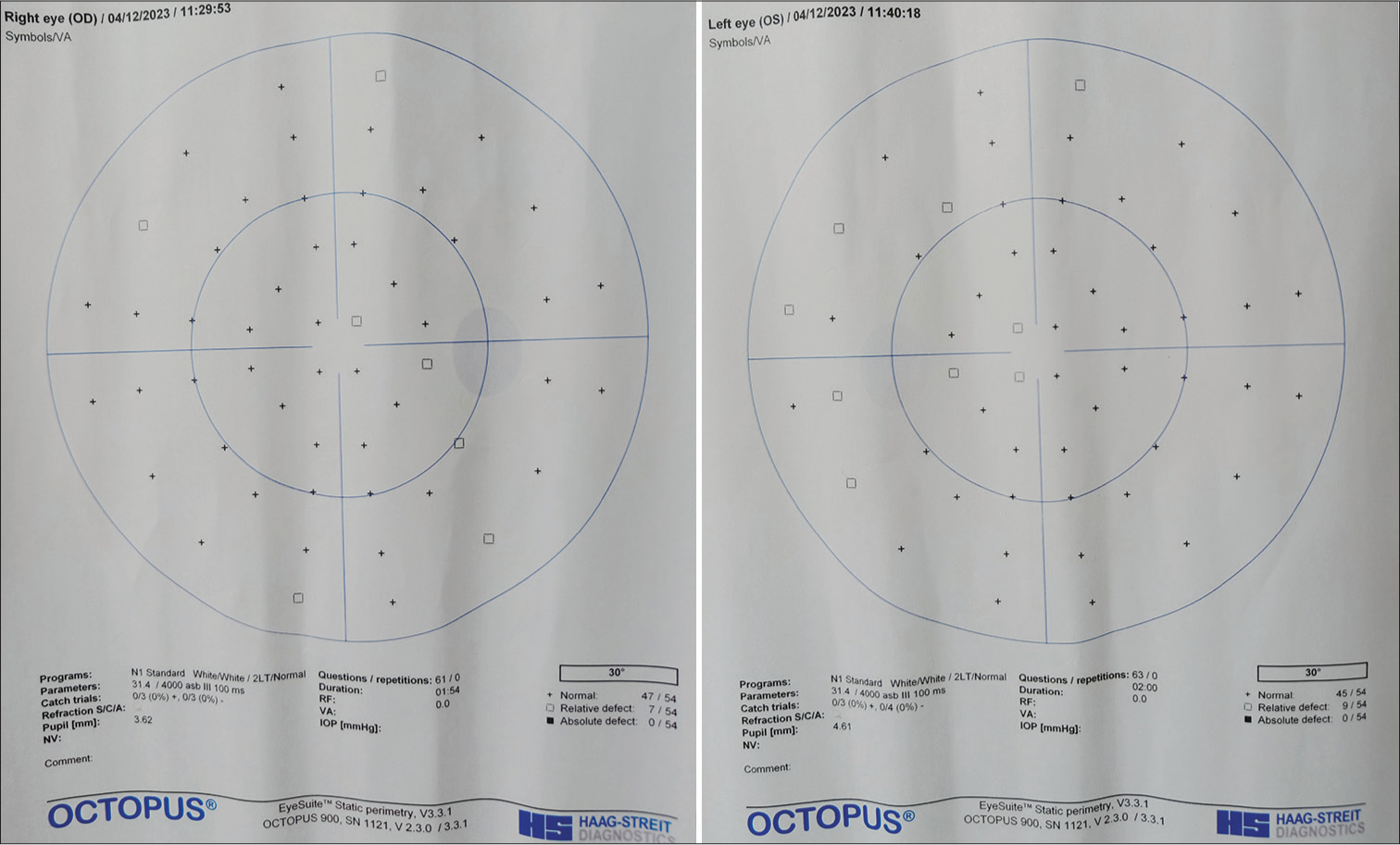 Neurological visual field report of this patient showing vertically aligned hemianopic relative defects in both eyes.