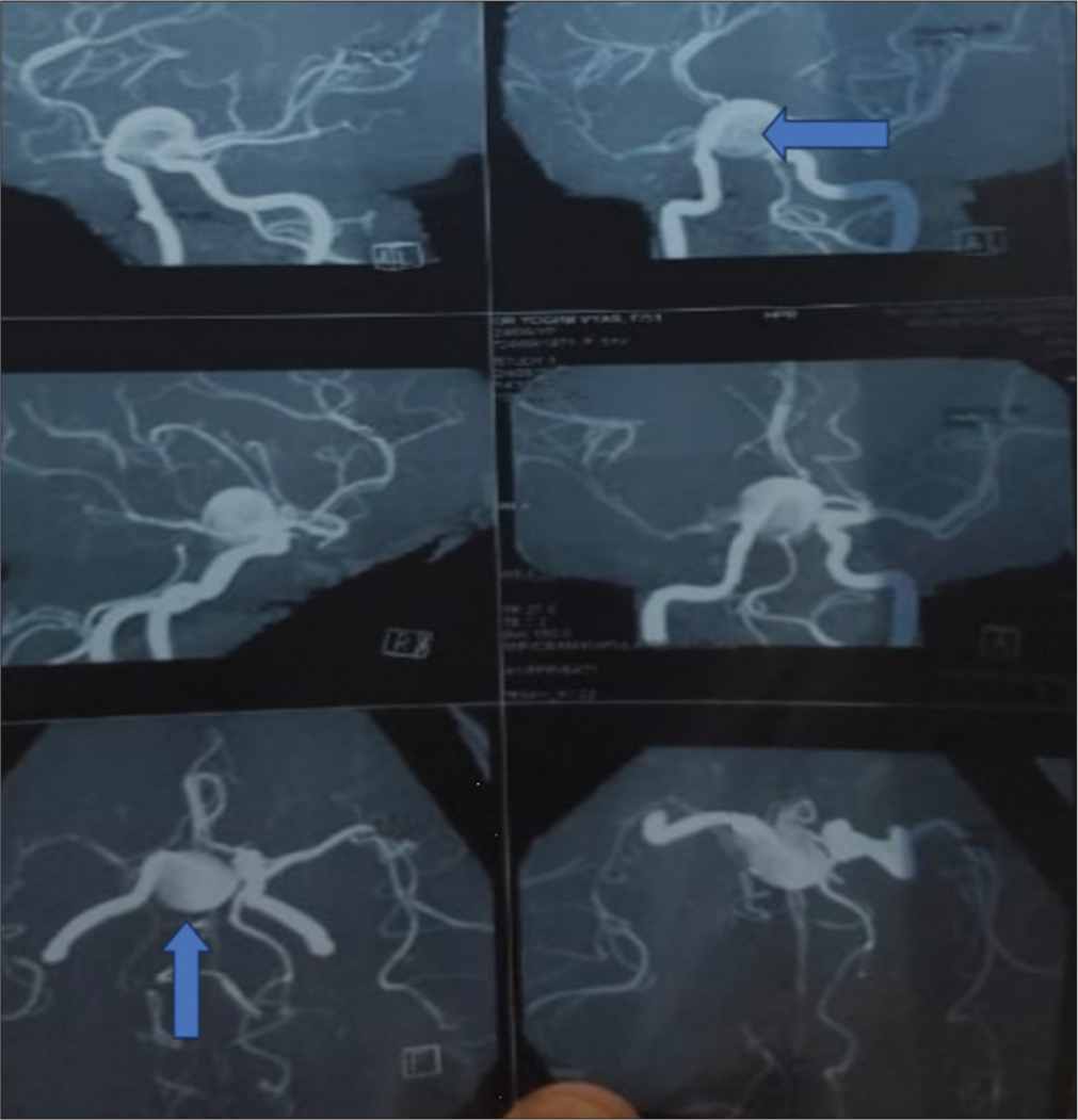 Magnetic resonance imaging brain with angiography showing the saccular aneurysm (blue arrow) at the junction of middle carotid artery and internal carotid artery.