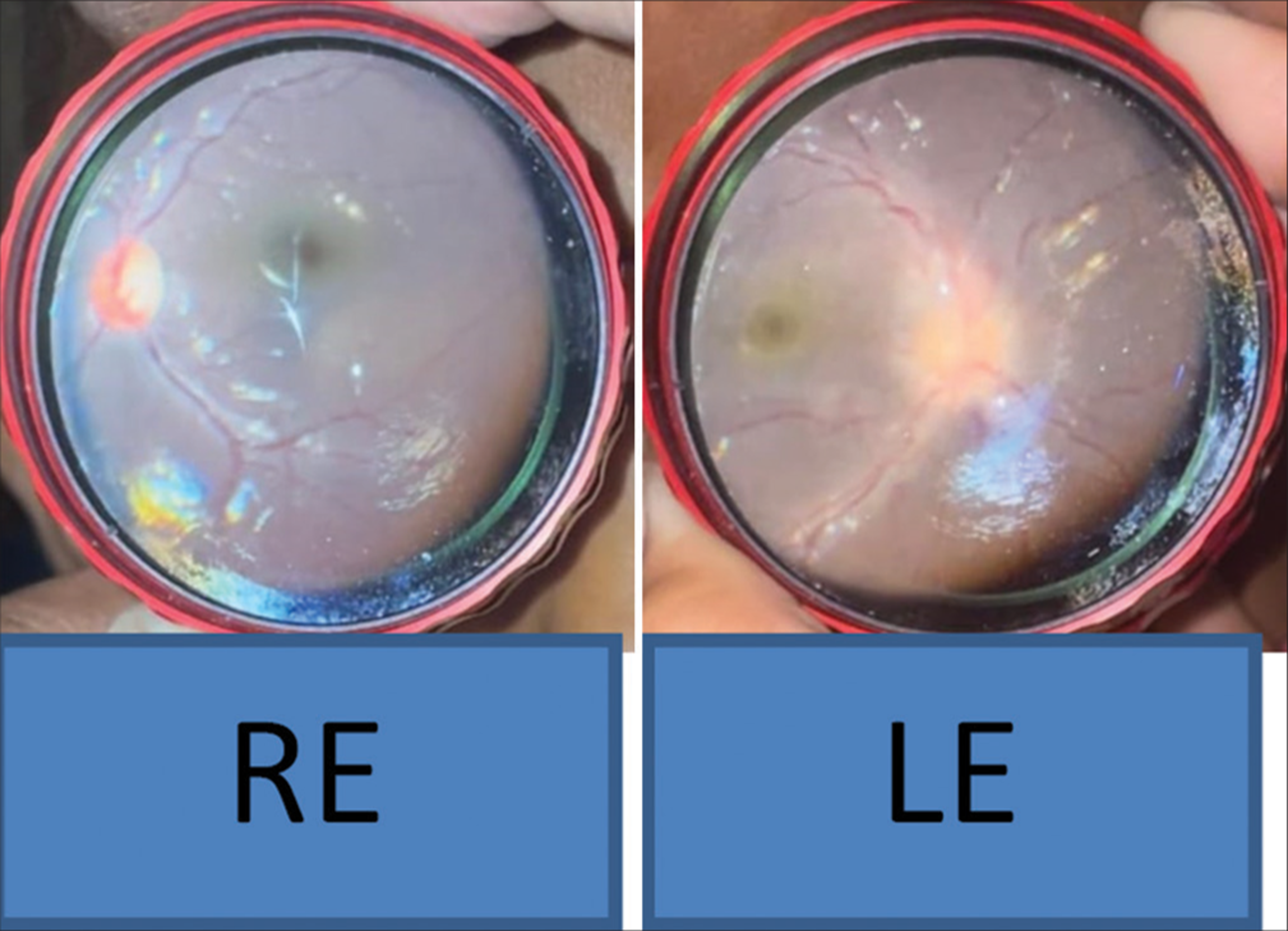 Case 2 - Left eye fundus showing blurred disc margin with unappreciable cup disc ratio. RE: Right eye LE: Left eye.