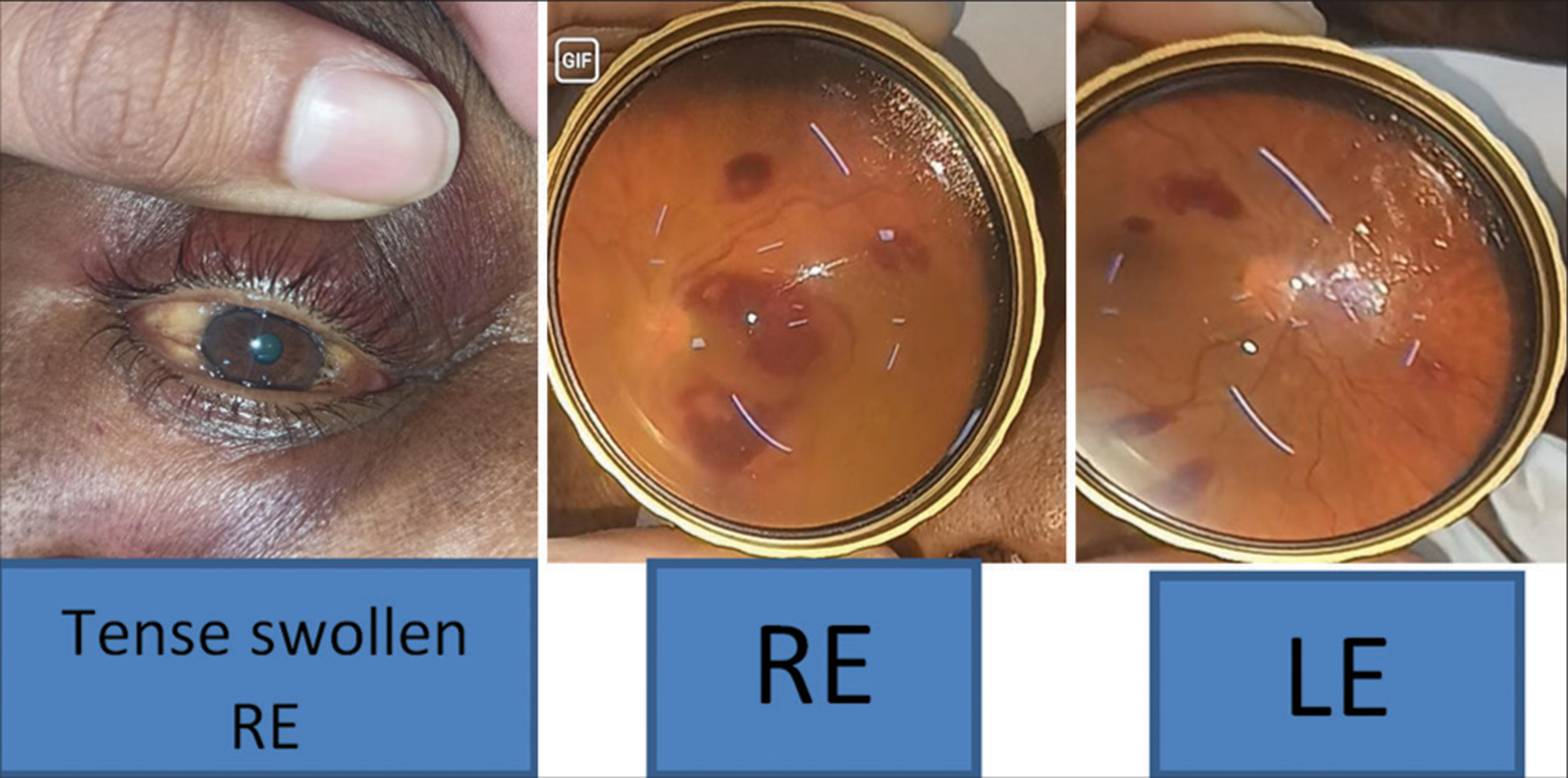 Case 3 - Right eye is tense swollen Fundus examination of right eye showing multiple subretinal hemorrhages, with tortous blood vessels and blurred disc margins. Fundus examination of left eye shows multiple subretinal hemorrhages with tortous blood vessels. RE: Right Eye, LE: Left Eye.