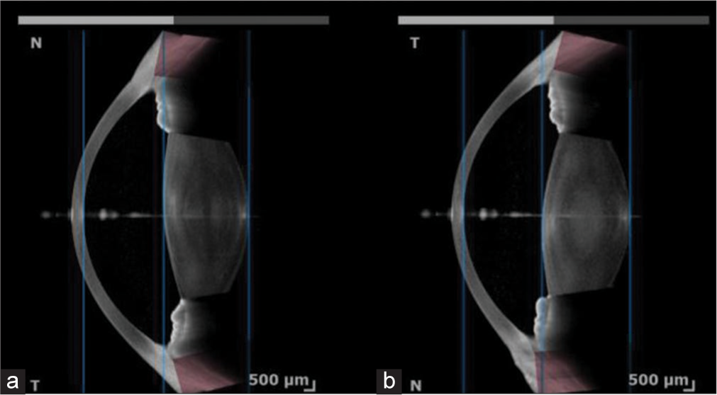 Picture of Swept-source anterior segment optical coherence tomography of (a) the right and (b) the left eye, respectively.