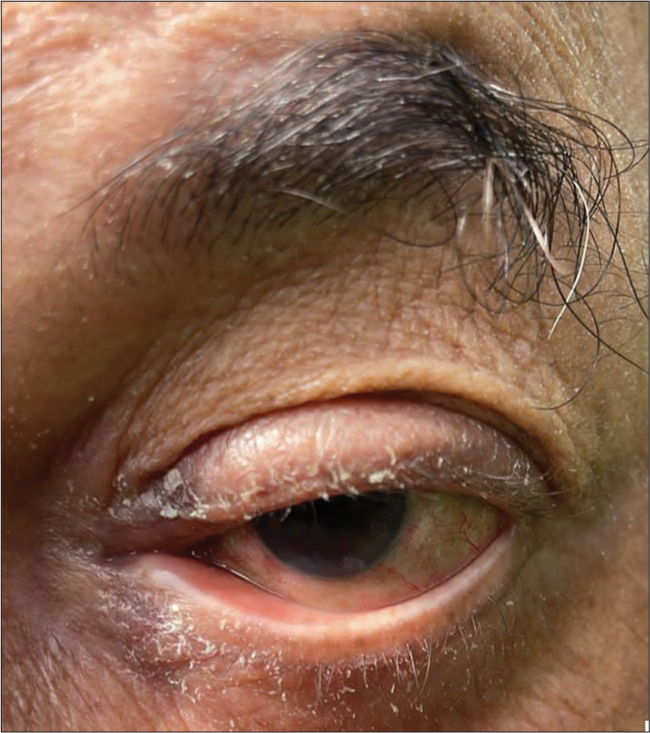 Periocular dermatitis with lower lid ectropion and punctal eversion.