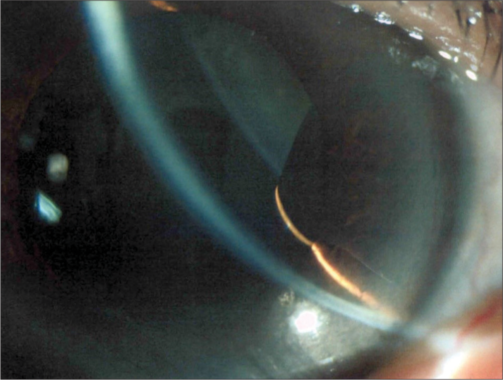 Negative transillumination of the cyst.