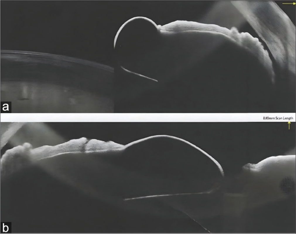 (a) Anterior segment optical coherence tomography. (b) Cyst of the iris posterior to the lens adjacent to the iris.