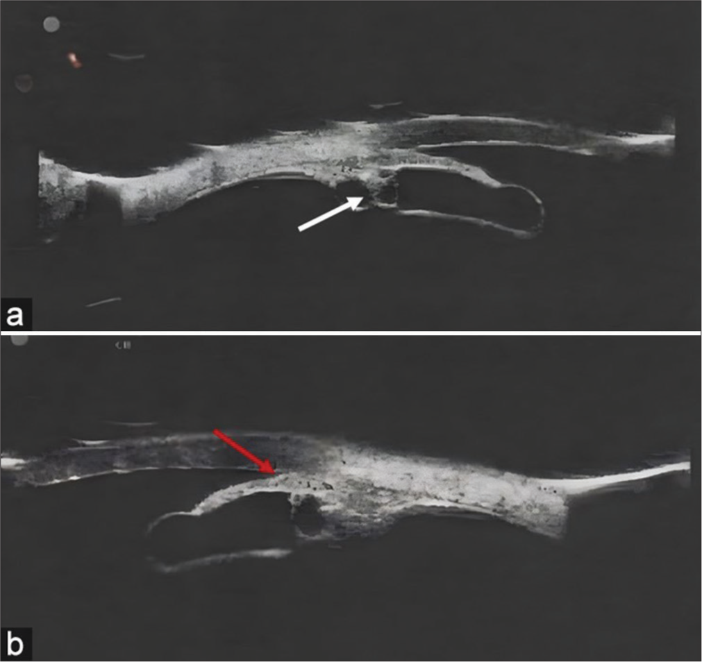 (a) Ultrasonic biomicroscopy (UBM) of the plateau iris with iridociliary cysts (white arrow). (b) UBM of the left eye showing iridociliary cysts with a closed iridotrabecular angle (red arrow).