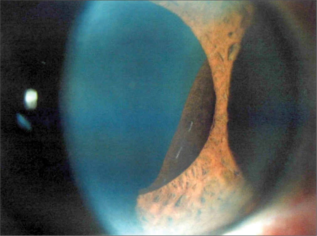 Peripheral pigment epithelial cyst on the inferotemporal sectoral pupillary margin.