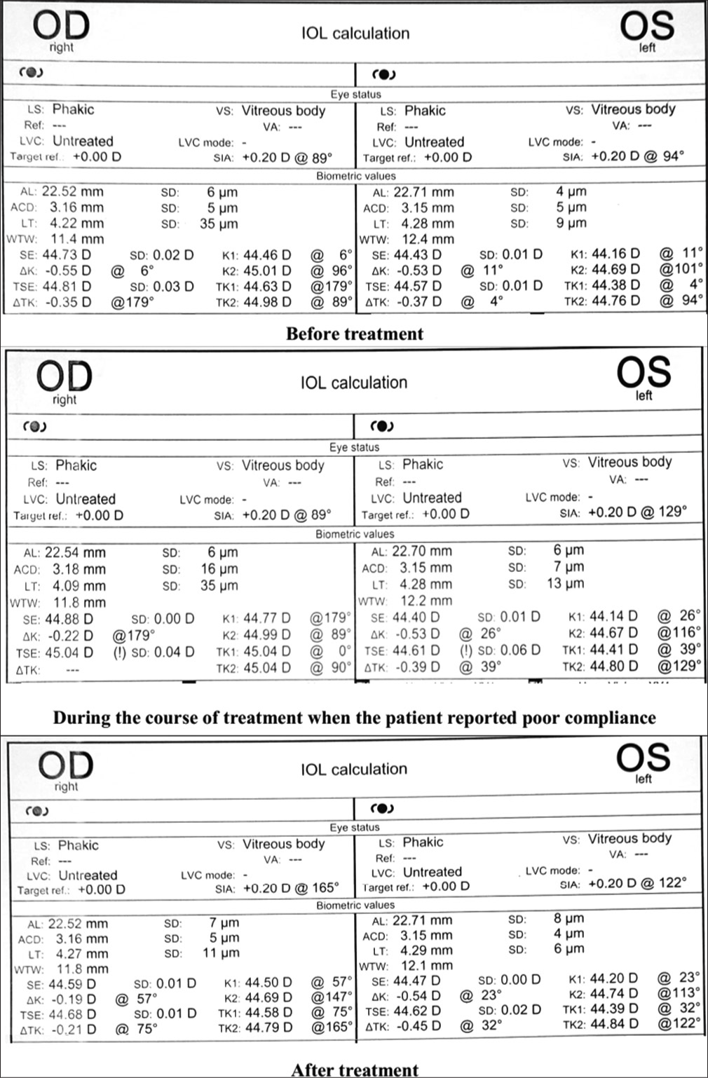 Intraocular lens master calculations through the course of treatment of the patient. OD: Right Eye, OS: Left Eye.