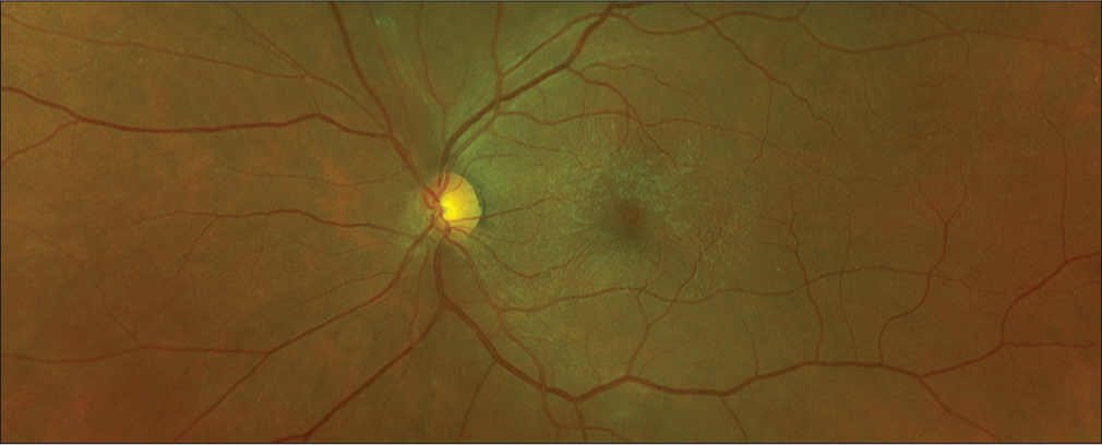 Optos colour picture showing cellophane reflex with a few retinal striae on the macula.