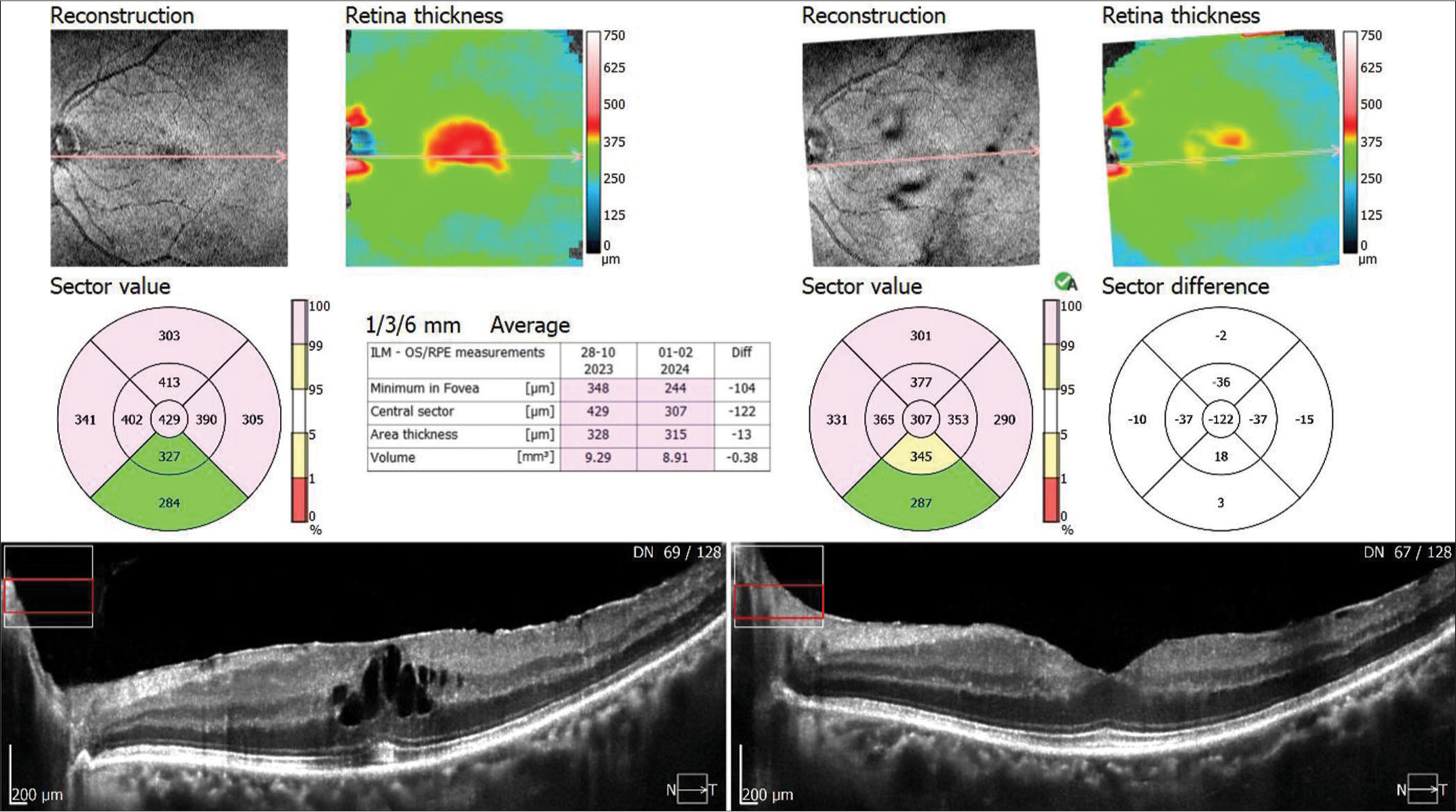 Comparative optical coherence tomography picture showing spontaneous separation of epiretinal membrane from the fovea with resolution of macular oedema. ILM: Internal limiting membrane, RPE: Retinal pigment epithelium, OS: Outer photoreceptor segment.