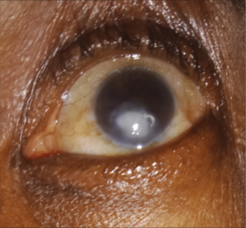 Showing a patient with corneal opacity following traditional eye medication use for presumed measles infection in childhood (courtesy of Dr. U Eze).