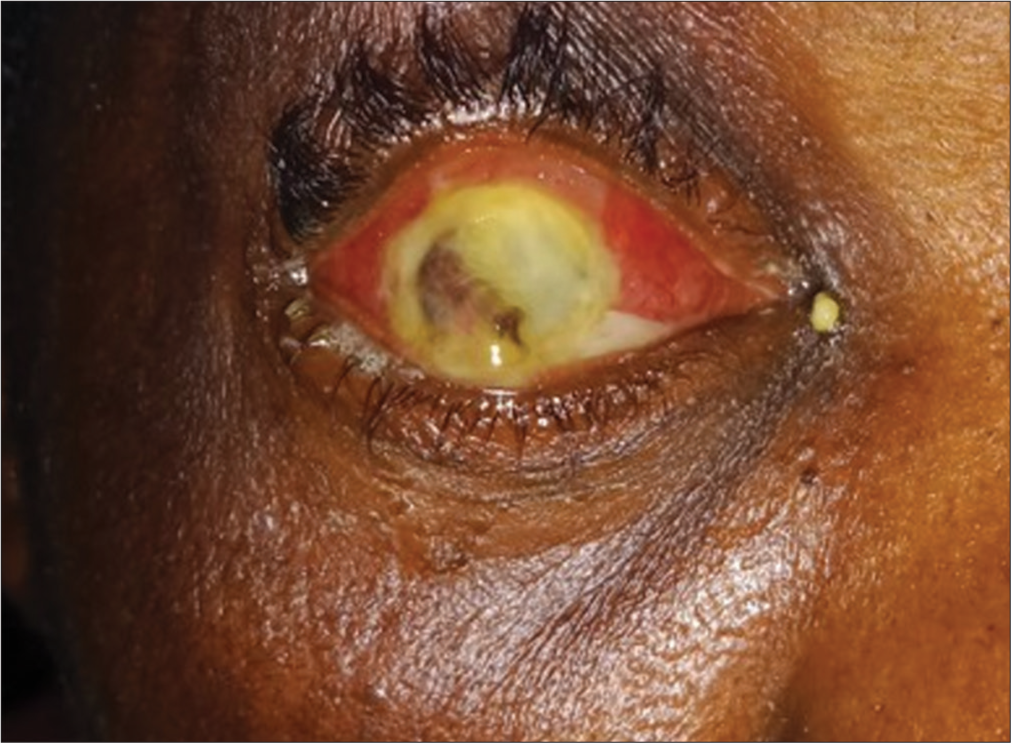 Panophthalmitis in a patient with a history of steroid and traditional eye medication use (courtesy of Dr. U Eze).