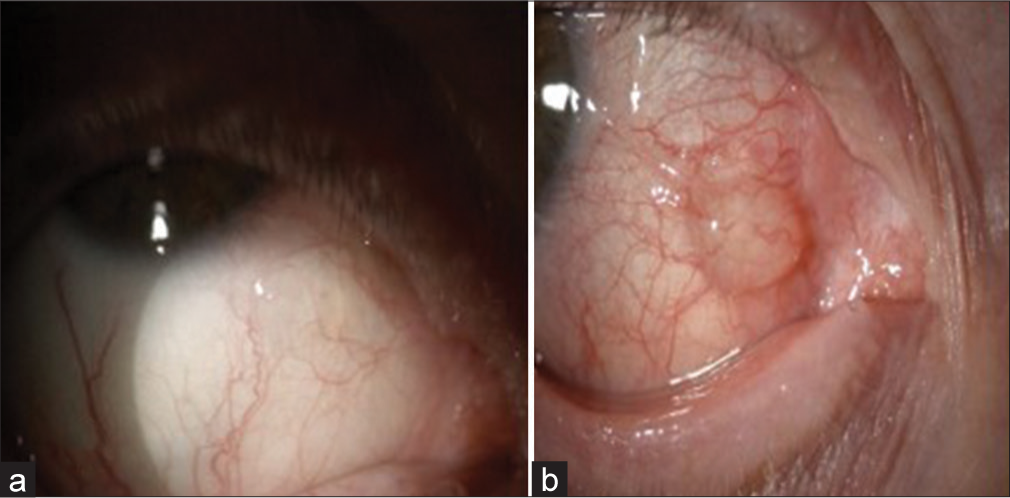 (a and b) Picture showing initial lesion and recurrence conjunctival cyst.