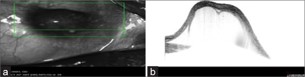 (a and b) Anterior segment optical coherence tomography of the lesion.