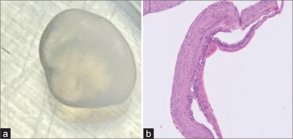 (a and b) Excised lesion and histopathological picture.
