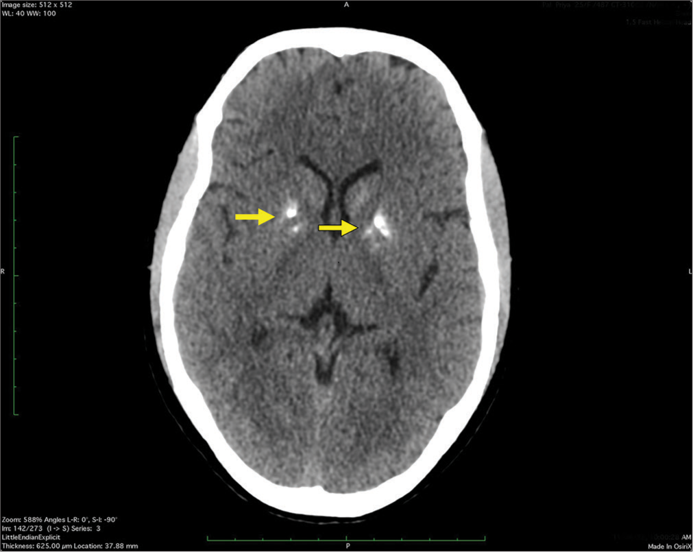 Computed tomography brain (plain) of a 25-year-old lady presenting with headache and blurring of vision diagnosed with primary hypoparathyroidism showing calcification in the bilateral lentiform nucleus (indicated by yellow arrows).