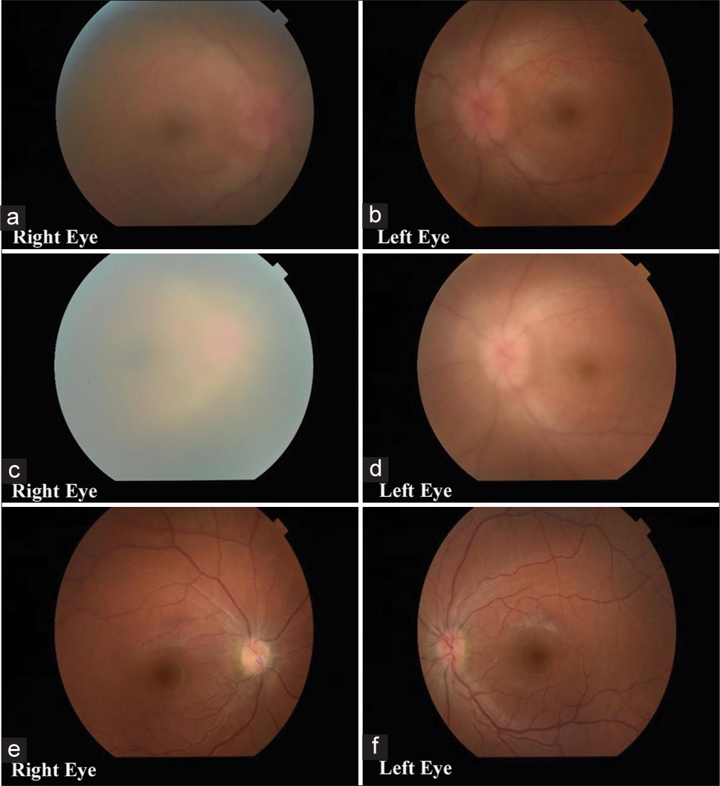 Fundus images of a 25-year-old lady presenting with headache and blurring of vision diagnosed with primary hypoparathyroidism. (a and b) Bilateral papilledema with venular dilatation and tortuosity; Hazy fundus view due to posterior subcapsular cataract. (c and d) Right eye cataract progression. Very hazy fundus view in the right eye with a mild reduction in disc oedema; venular tortuosity and dilatation compared to the previous examination. (e and f) A clear view of the fundus after cataract surgery. Resolving disc oedema with a reduction in venous dilatation and tortuosity is seen.