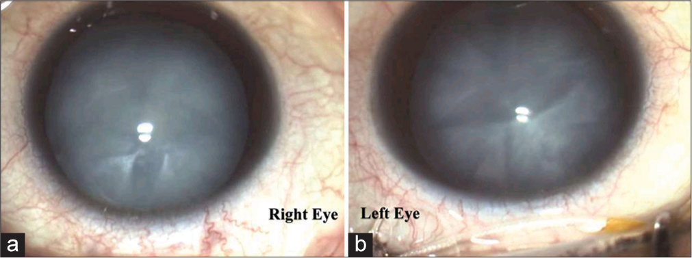 (a and b) Ocular images of a 25-year-old lady presenting with headache and blurring of vision diagnosed with primary hypoparathyroidism showing mature cataracts in both eyes.