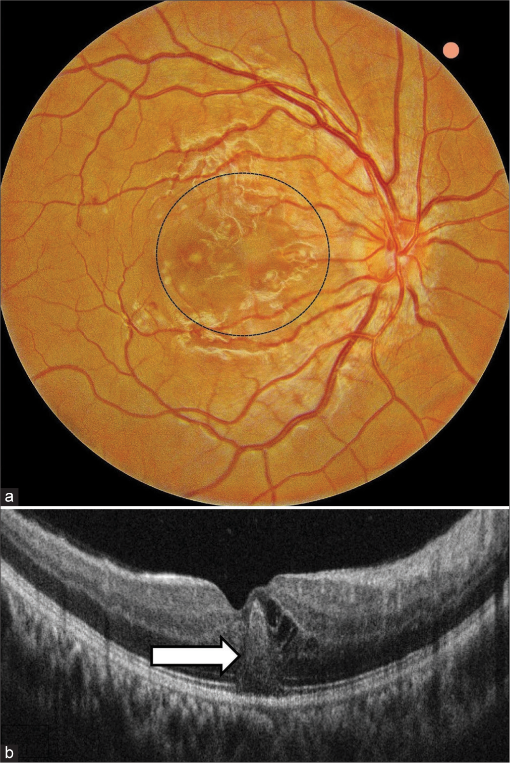 (a) Colour fundus photograph of the right eye showing multiple focal ill-defined yellowish subretinal patches associated with retinal oedema centred on the posterior pole (circle) associated with few superficial retinal haemorrhages and venous tortuosity. (b) Optical coherence tomography documenting classic foveolitic picture (arrow) with conical protrusion of hyperreflective material in outer retina along with cystoid swelling in inner retinal layers.