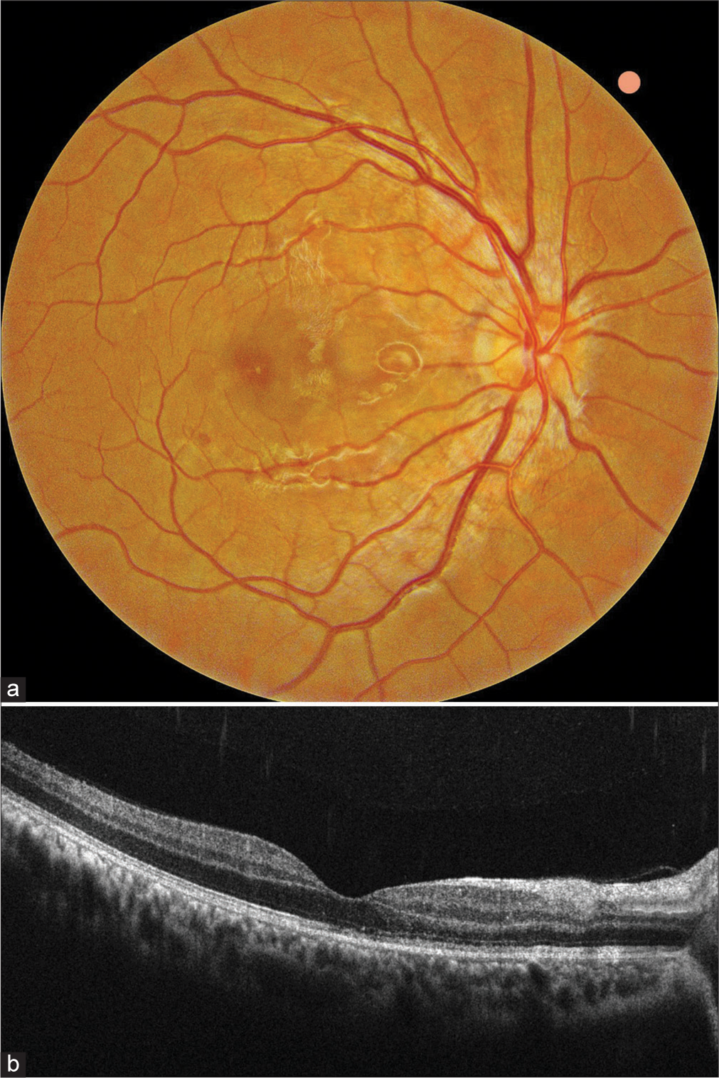 (a) Post-treatment fundus photograph showing resolution of dengue maculopathy. (b) Optical coherence tomography documenting complete restoration of foveal structure with intact external limiting membrane and outer retinal layers.