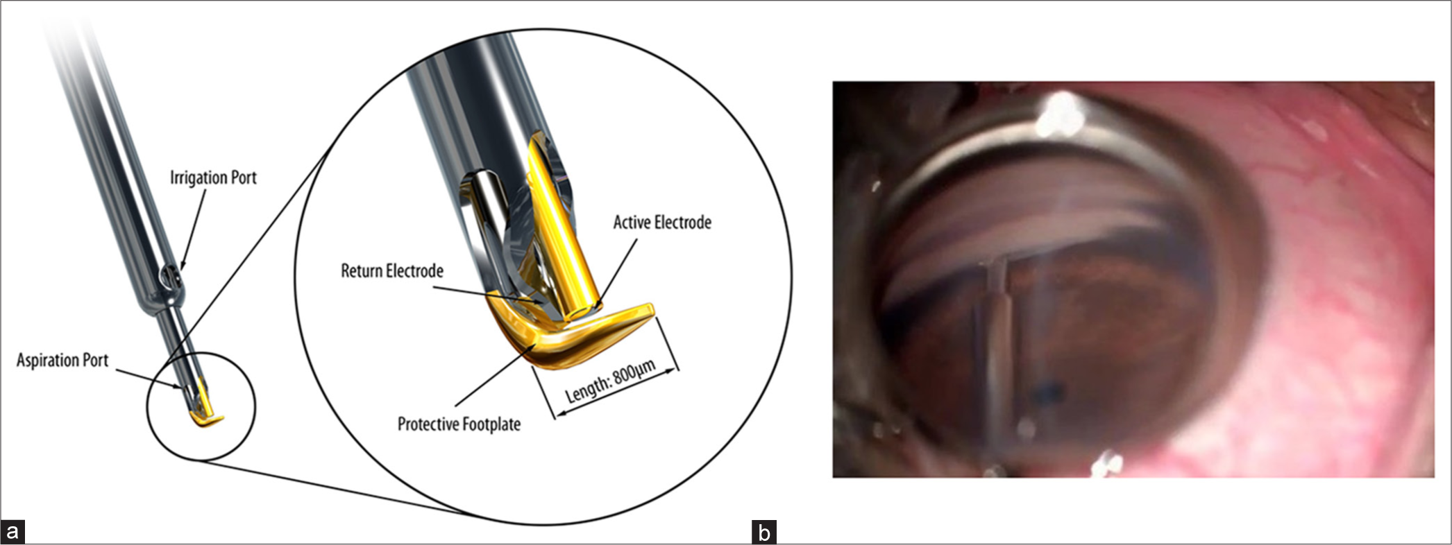 (a) Trabectome (Courtesy: Prof Guss Guzzard, Moorfields Eye Hospital). (b) Intra operative gonioscopy image of Trabectome (Courtesy: Dr SD, SCEH).