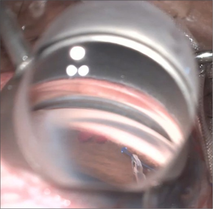 Suture gonioscopy assisted transluminal trabeculotomy (Courtesy: Dr. SD, SCEH).