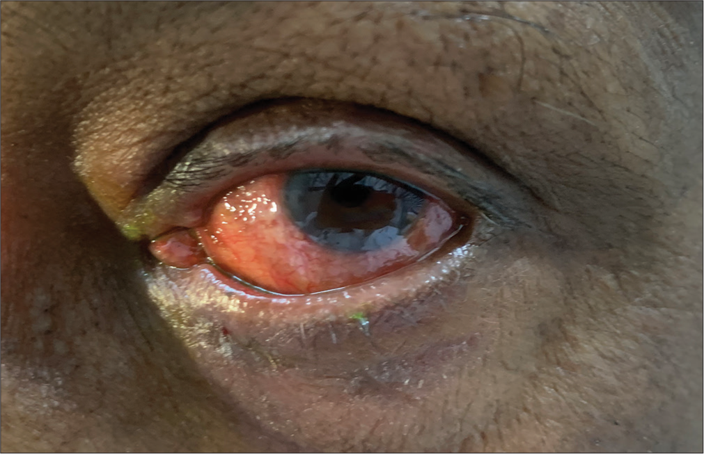 Lower lid medial ectropion with punctal eversion.