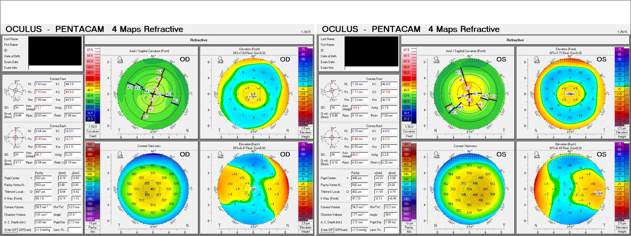 Pre-operative Scheimpflug imaging showing corneal topography after Presbyond in the right eye and left eye. OD: Oculus dexter, OS: Oculus sinister.
