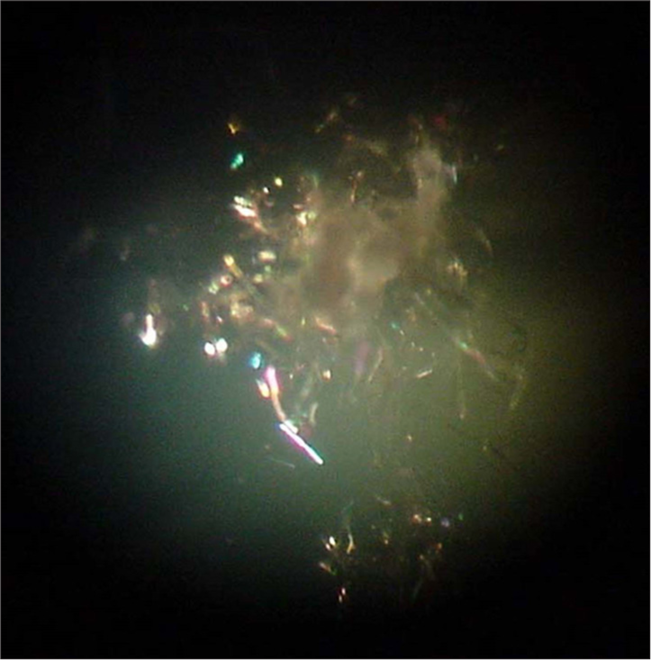 Slit-Lamp Examination: Polychromatic, refractile needles with brightly-coloured end points in the nucleus forming “Christmas Tree” pattern plus a posterior subcapsular cataract.