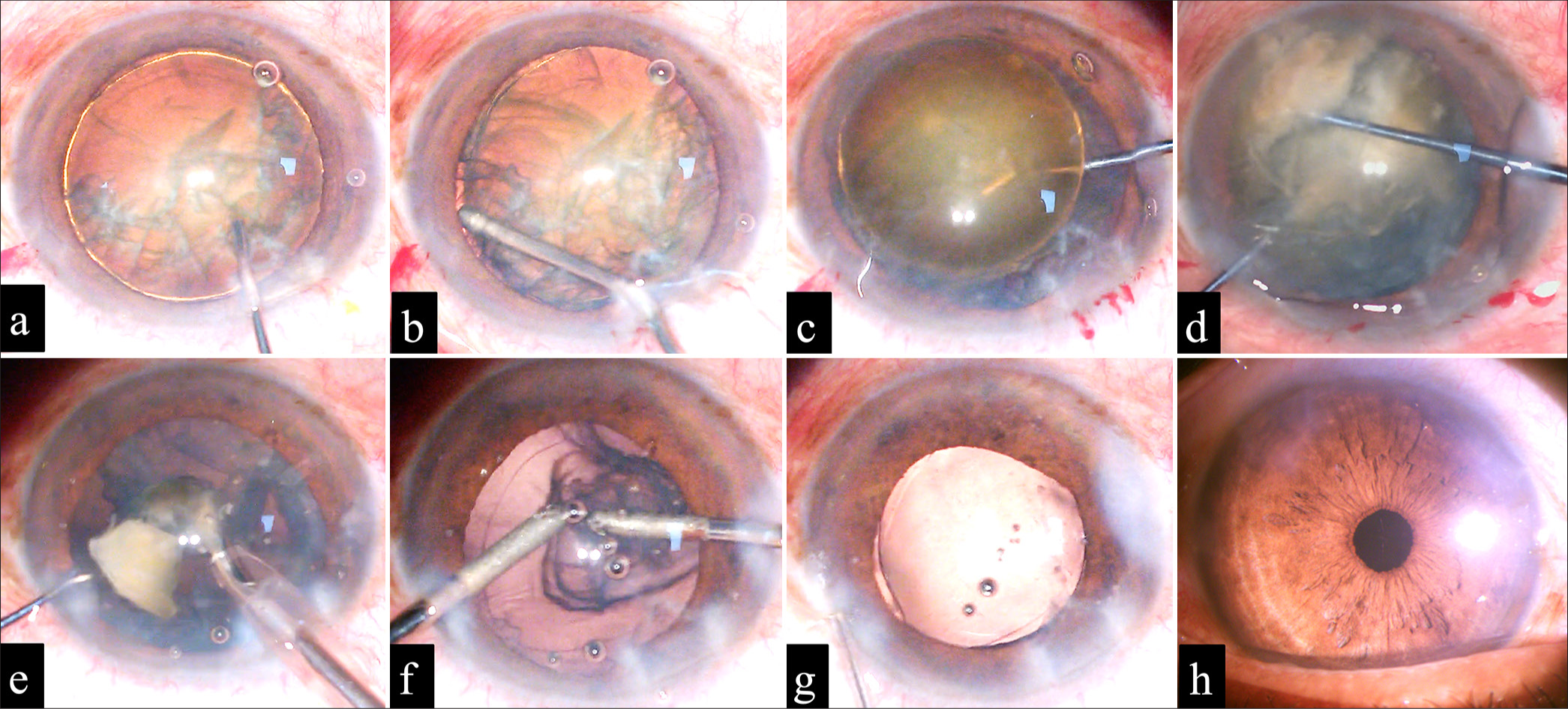 (a-h) (a) The successful hydrodelineation indicated by golden ring. (b) Successful viscodelineation using Hydroxypropylmethyl cellulose (HPMC) 2%, which completely disassembled the endnucleus from the epinucleus. (c) The prolapse of the nucleus using the Y rotator. (d) The manual crushing of the nucleus using Two-Y rotators. (e) The emulsification of the nucleus using phaco probe in the iris plane. (f) The removal of epinucleus using irrigation and aspiration. (g) The implantation of the single-piece intraocular lens in the capsular bag. (h) The clear cornea at post-operative day 1.