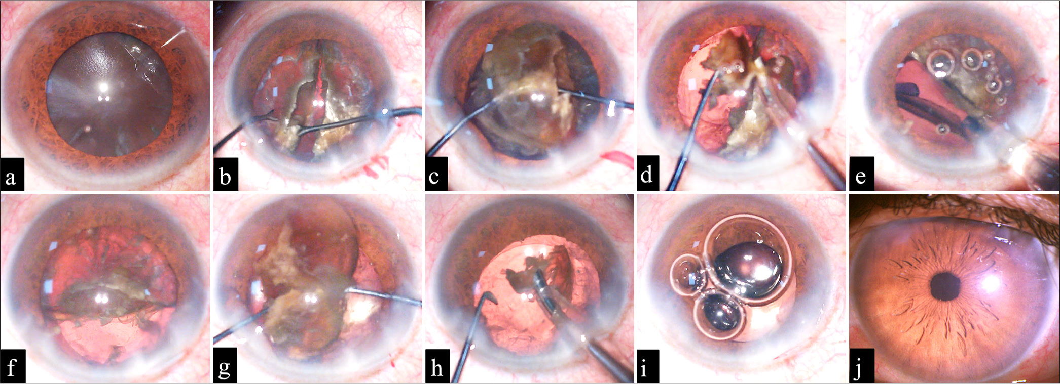 (a-j) (a) The deep brown hard cataract. (b) Prolapsing one nucleus half after successfully cracking into the anterior chamber using a Two-Y rotator. (c) The crushing of one nucleus half into multiple pieces using a Two-Y rotator. (d) Phacoemulsification of the crushed nucleus half in the iris plane. (e) The implantation of intraocular lens (IOL) into the bag. (f) The IOL unfolded below the second nucleus half. (g) The crushing of the second nucleus half was carried out using Two-Y rotators. (h) The phacoemulsification of the second half nucleus in the iris plane. (i) The implanted single-piece IOL in the capsular bag with the ports are sealed. (j) shows the clear cornea at post-operative day 3.
